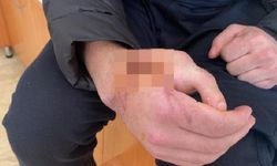 Kopan el parmağı yerine ayak parmağı dikildi