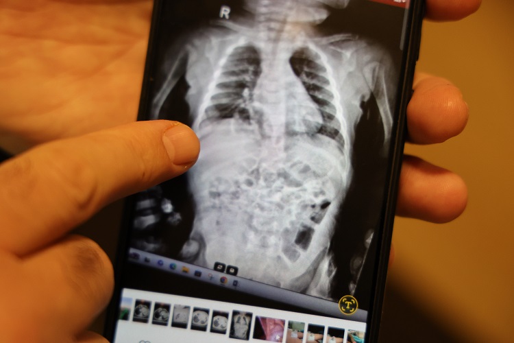 Diyarbakır’da Mucize Kurtuluş! 200 Binde Görülen Hastalıktan 1 Saatte Kurtuldu (2)